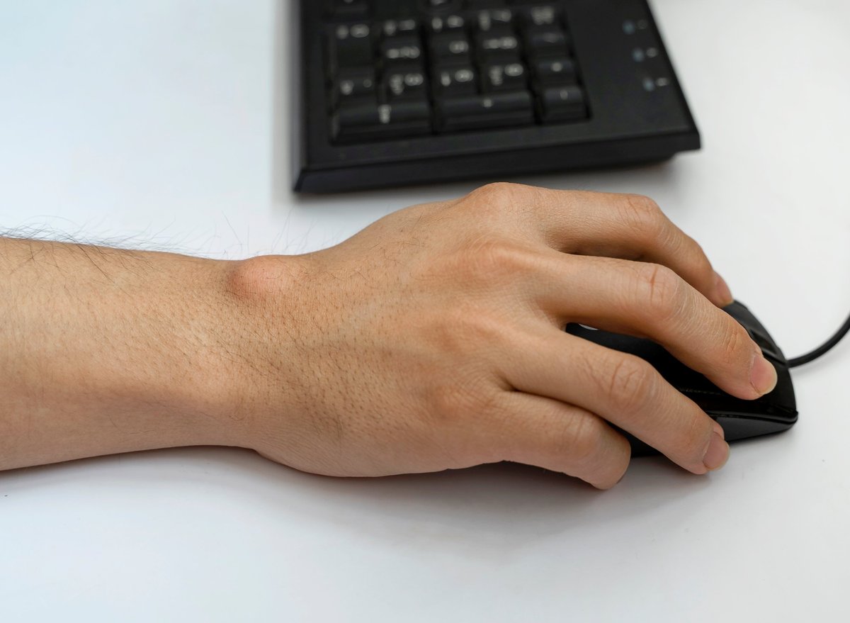 Fluid-filled ganglion cyst visible on the back of a hand, the typical location near a wrist joint