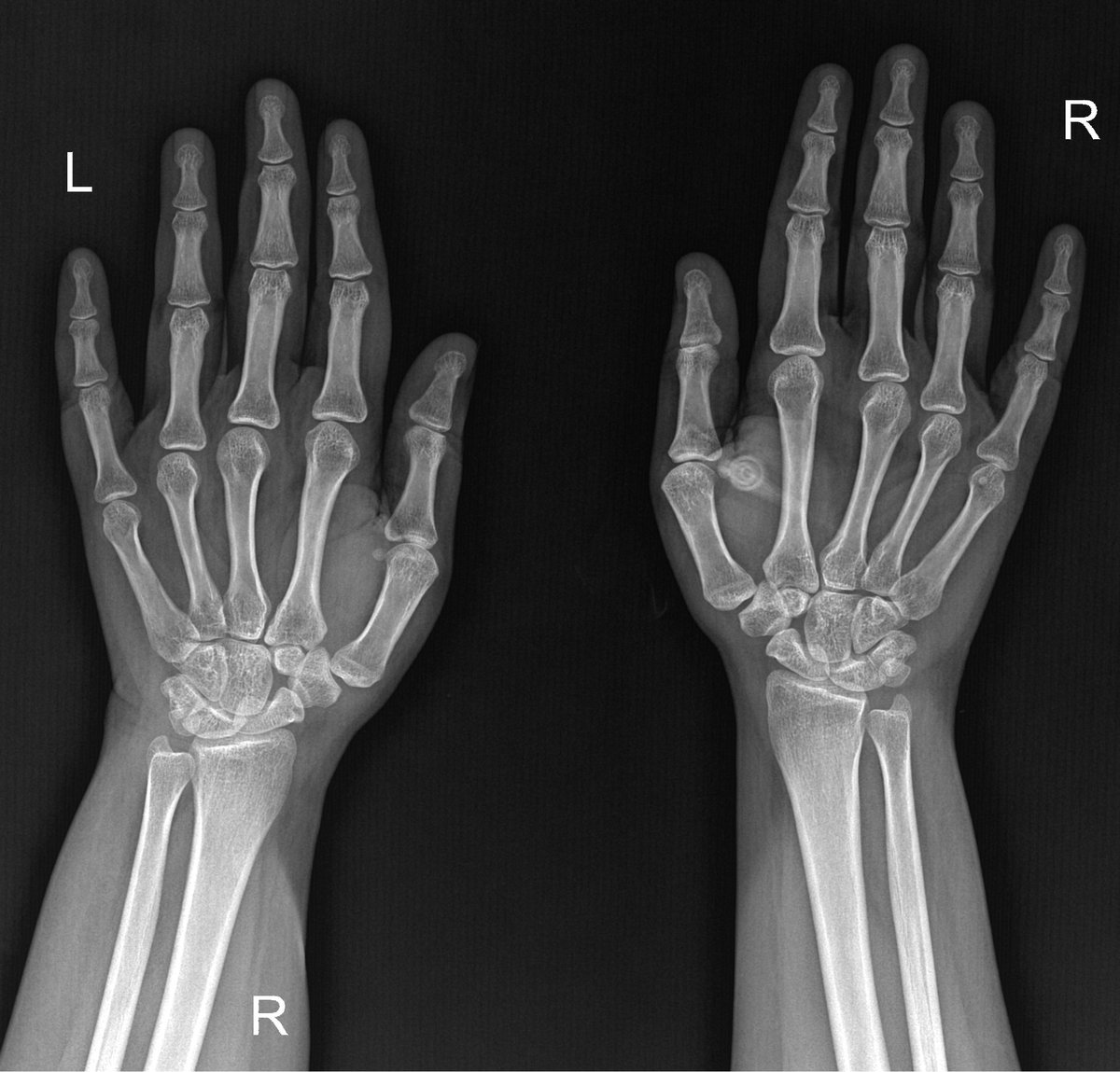 Hand and wrist X-ray showing the distal radius and carpal bones evaluated for fracture