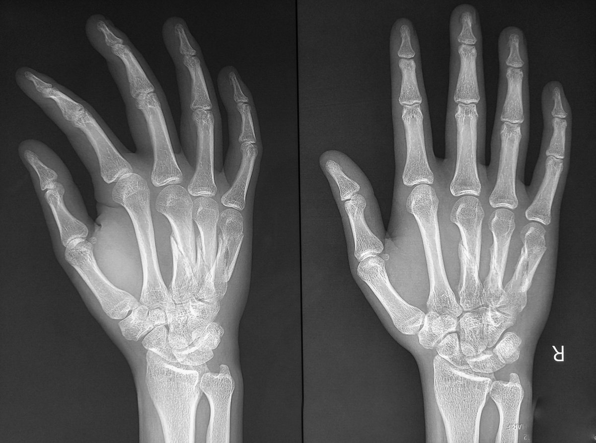 X-ray of a hand and wrist showing the carpal bones where a scaphoid fracture occurs