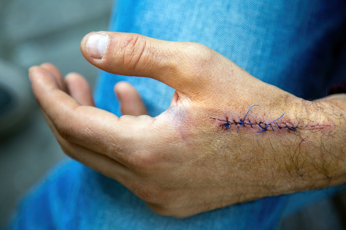 Close-up of a hand showing a healing incision after orthopedic surgery