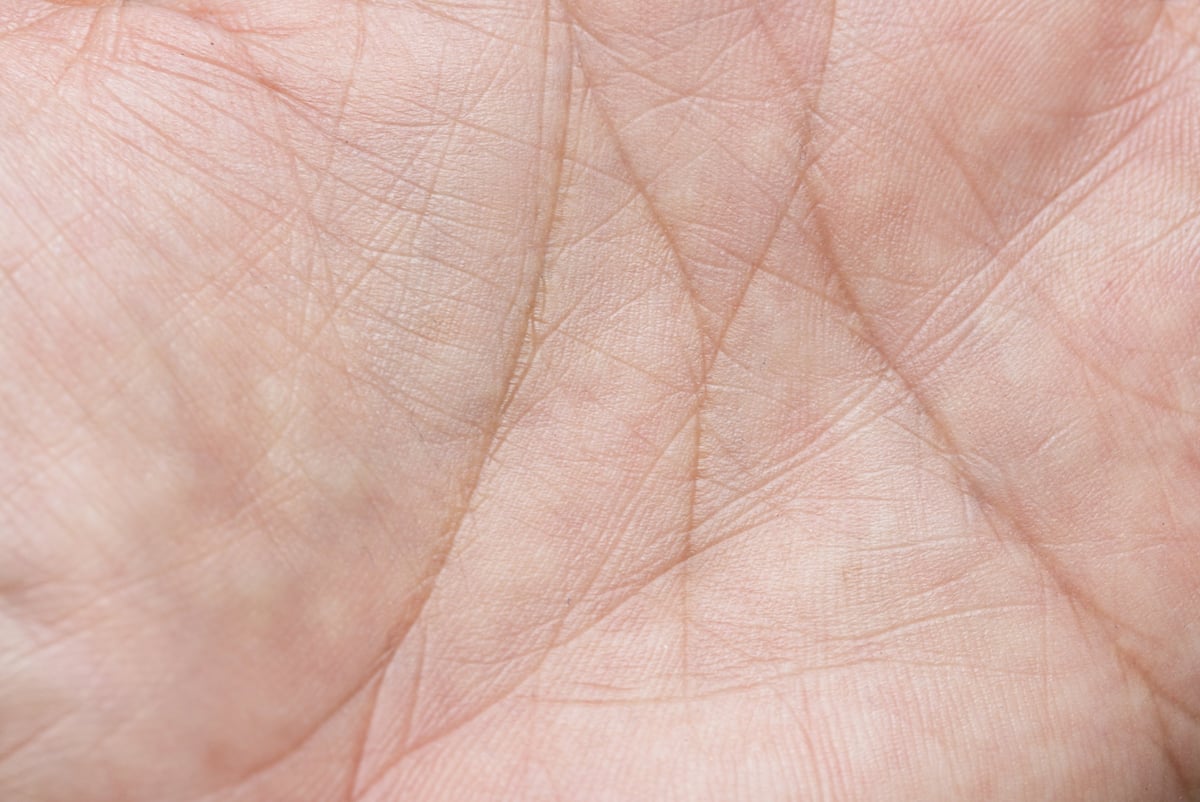 Close-up of an open human hand showing the palm and fingers affected by median nerve compression